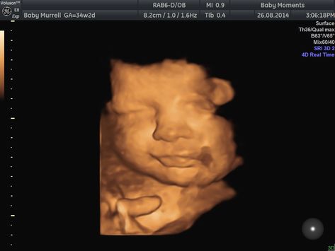 This is our 4d baby scan done our clinic Baby Moments. Look at the baby scan 16 Weeks Pregnant Belly, 16 Weeks Pregnant Ultrasound, Edwards Syndrome, Pregnancy Scan, 20 Week Scan, 3d Ultrasound, 4d Ultrasound, Medical Ultrasound, Baby Ultrasound