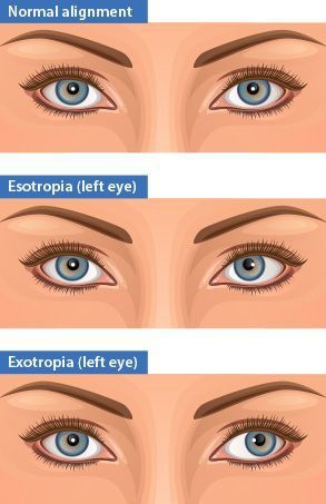 Strabismus Surgery, Crossed Eyes, Dry Eyes Causes, Swollen Eyes, Two Eyes, Eye Damage, Irritated Eye, Vision Therapy, Ghost Images