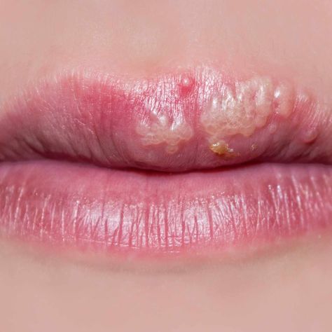 a close-up of a woman's lips, with cold sores Remedies For Cold Sores Lips, Cold Sores On Lips, Best Cold Sore Remedy Overnight, How To Prevent Cold Sores, How To Heal A Cold Sore Fast, How To Stop A Cold Sore Before It Starts, Home Remedy For Cold Sore On Lip, Lip Sore Remedy, Cold Sore Remedy Quick Overnight