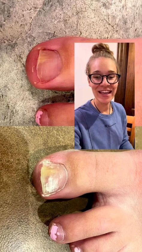 How to treat fungal nail infection Toenail Health, Nail Remedies, Nail Fungus Remedy, Fungal Nail, Diy Skin Care Recipes, Tapeta Galaxie, Toenail Fungus, Healthy Skin Tips, Beauty Remedies