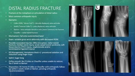 Distal Radius Fracture Distal radius fracture is ... Distal Radius Fracture, Bone Fracture, Radiology, Anatomy, Quotes, Quick Saves