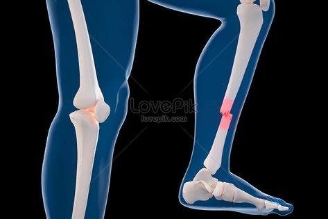 leg bones, bone fractures, fractures, displacement, dislocation#Lovepik#creative Fracture Photo, Bone Fracture, Leg Bones, Energy Logo, Digital Media Marketing, Copy Print, Image File Formats, Scene Image, Lighting Logo