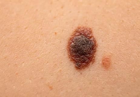 How To Tell if a Mole Is Cancerous: 8 Signs Cancerous Moles, Red Moles, Skin Moles, Cleveland Clinic, 8th Sign, Best Detox, Healthy Routine, Detox Drinks, Mole