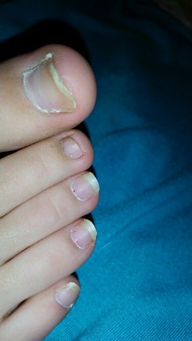 Are you toenails braking off, well no more yucky tonails, are they dirty and ugly? Soak them in BAKING SODA and PROXCIDE for 30 min, for 2 weeks, once you have done that wipe off some of the baking soda and put socks on, and sleep with them on over night, NOTE: make sure your toes are clean, and put as much baking soda and peroxide as needed until it is liquidy and kind of thick, HAVE FUN!!!! FOLLOW ME FOR MORE GREAT STUFF Ugly Toenails, Homemade Foot Soaks, Listerine Foot Soak, Diy Foot Soak, Foot Soak Recipe, Baking Soda Scrub, Baking Soda Bath, Baking Soda Face, Baking Soda Benefits