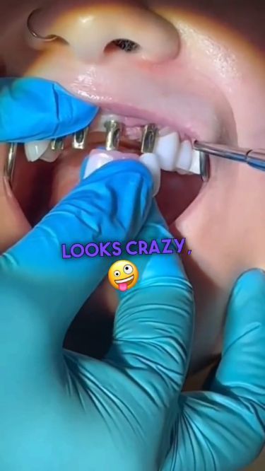 Whiten Teeth At Home, Dental Photos, Affordable Dental Implants, Dental Videos, Digestive Problems, Perfect Teeth, Whiten Teeth, How To Prevent Cavities, Dental Humor