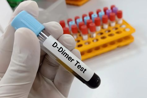 Understanding D-Dimer and 10 Strategies to Reduce It - Suzy Cohen suggests ways to heal naturally without medication D Dimer Test, Medical Analysis, Coagulation Cascade, D Dimer, Leg Veins, Ways To Heal, Respiratory Illness, Medical Laboratory, Blood Test