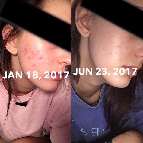 [acne] a little late but almost 6 months on tretinoin and I am loving the results! routine in comments. Tretinoin Before And After Acne, Tretinoin Before And After, Before And After Acne, Beauty And Health, Photos Ideas, Hair Skin, Hair Nails, 6 Months, Selfies