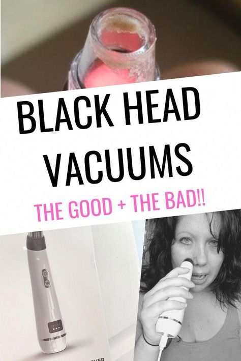 Blackhead Vacuums range in price, I tried a cheaper model to see how it held up. Included in this review is a video, trying the product for the first time. Skin Vacuum, Blackhead Remover Diy, Big Pores, Pore Vacuum, Blackhead Vacuum, Blackheads On Nose, Blackhead Mask, Vacuum Reviews, Prevent Pimples