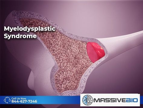 Myelodysplastic Syndrome, Pelvic Bone, Bone Marrow, Things Under A Microscope, Types Of Cancers, Blood Test, Blood Cells, The Bone, Clinical Trials