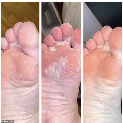 Real results: The Plantifique foot peel mask is no joke, as its lactic acid content begins the gradual sloughing away process - eventually leaving your feet baby soft Neck Tightening Cream, Foot Peel Mask, Neck Tightening, Dry Cracked Heels, Peeling Mask, Budget Beauty, Foot Mask, Callus Removal, Going Viral