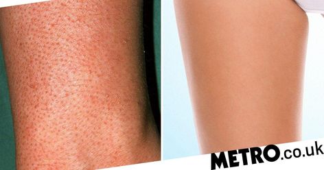 How to get rid of strawberry legs | Metro News Strawberry Leg Scrub, Leg Scrub, Strawberry Legs, Onion For Hair, Natural Disinfectant, Skin Growths, Smooth Legs, Aloe Gel, Ingrown Hair