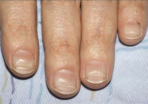 http://www.nailsmag.com/article/116697/something-to-talk-about-beaus-lines Horizontal Ridges In Fingernails, Dents In Nails, Horizontal Nail Ridges, Nail Health Signs, Fingernail Health, Nail Disorders, Pale Nails, Nail Ridges, Nail Signs