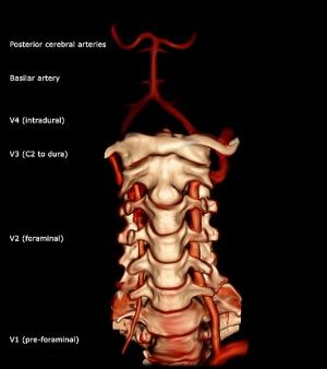 Vertebral Artery Test - Physiopedia Neurosurgery Study, Arteries Anatomy, Forensic Pathology, Thoracic Duct, Subclavian Artery, Subarachnoid Hemorrhage, Occipital Neuralgia, Vertebral Artery, Headache Types