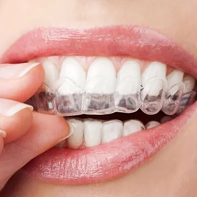 Retainer Teeth, Teeth Clenching, Activated Charcoal Teeth Whitening, Teeth Whitening Gel, Charcoal Teeth Whitening, Teeth Bleaching, Teeth Whitening Pen, Teeth Whitening Strips, Smile Teeth