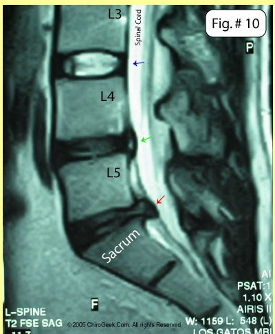 L5 S1, Bulging Disc, Hip Flexor Stretch, Tight Hip Flexors, Spine Health, Psoas Muscle, Sciatic Nerve Pain, Sciatic Nerve, Joints Pain Relief