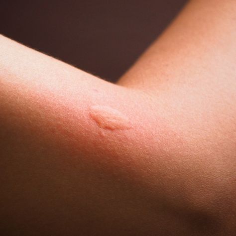 How to Get Rid of Mosquito Bites | Glamour Get Rid Of Mosquito Bites, Allergic To Mosquito Bites, Losing A Dog Quotes, Ant Bites, Differin Gel, Bug Bite, Brown Recluse, Tick Bite, Bed Bug Bites