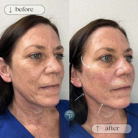 ✨ Another incredible #SculptraTransformation! Witness the magic of sculpting natural beauty with every injection. Discover ALL of the benefits of Sculptra at Skintellect, visit the link to schedule your injectable consultation! :)   #sculptra #sculptratampa #tampamedspa #antiaging https://skintellectonline.com/injectables/ Sculptra Aesthetic, Facial Aesthetics, Beauty Goals, Beauty Advice, Med Spa, The Magic, Natural Beauty, Facial, Benefits