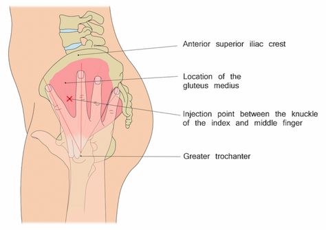 Dorsogluteal Injection Site, Menopur Injection Tips, Ventrogluteal Injection Site, Im Injection Sites Nursing, Subcutaneous Injection Sites, Ventrogluteal Injection, Intramuscular Injection Sites, Im Injection Sites, Nursing Tools