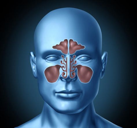 sinusitis and viral meningitis Relieve Sinus Pressure, Home Remedies For Sinus, Sinus Congestion Relief, Sinus Cavities, Sinus Infection Remedies, Remedies For Tooth Ache, Sinus Pain, Mold Exposure, Sinus Problems