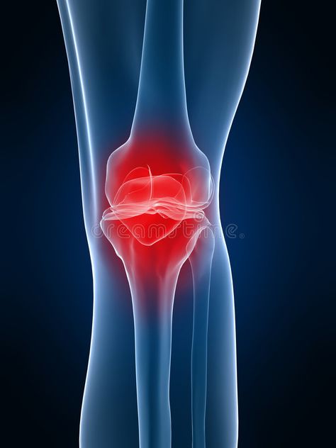 Painful knee. 3d rendered x-ray illustration of a human knee with pain , #AFFILIATE, #rendered, #knee, #Painful, #ray, #pain #ad Human Knee, Flexibility And Mobility, Turmeric Curcumin, Joints Pain Relief, Marathons, Digital Painting Tutorials, Healthy Lifestyle Tips, Lifestyle Tips, Knee Pain