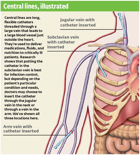 Central line sites Med Surg Nursing, Central Line, Nursing Pins, Oncology Nursing, Respiratory Therapy, Med Surg, Emergency Medical Services, Care Hospital, Nursing Tips