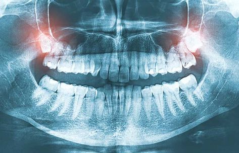 Common Signs You Need to Get Wisdom Teeth Removed | Absolute Dental Wisdom Teeth Recovery, Impacted Wisdom Teeth, After Wisdom Teeth Removal, Dental Spa, Wisdom Tooth Extraction, Dental Implant Surgery, Dental Implants Cost, Wisdom Teeth Removal, Tooth Removal