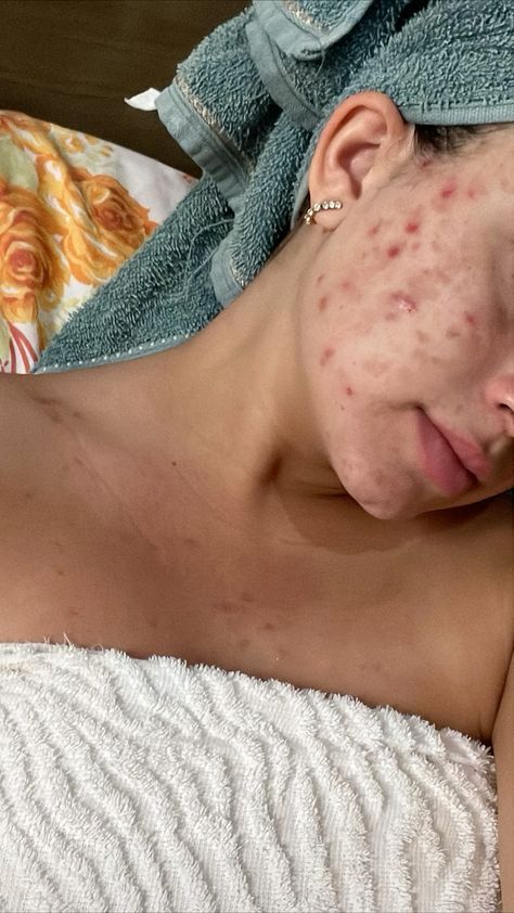 Bad Skin Pictures, Body Acne Positivity, Acne Skin Aesthetic, Bad Acne Pictures, Pimples Aesthetic, Breakouts On Face, Acne Appreciation, Acne Positive, Strawberry Freckles