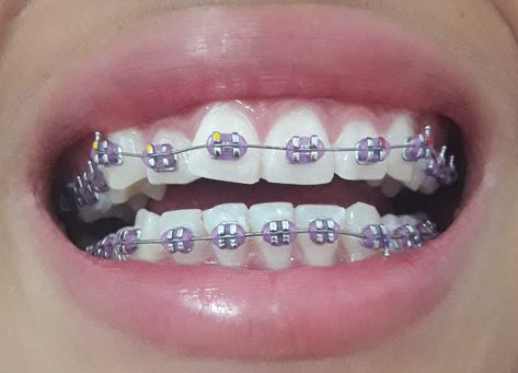 Dental Braces Colors, Invisible Teeth Braces, Natural Teeth Whitening Diy, Cute Braces Colors, Misaligned Teeth, Adult Braces, Braces Tips, Getting Braces, Braces Girls