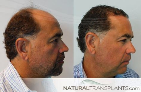 Norwood Monday - Weekly after hair transplant image featuring Norwood 5 and Norwood 6 men. Contact us now for a free of charge hair transplant consultation at 844-327-4247.  .  .  .  .  #norwoodmonday #norwood5 #norwood6 #afterhairtransplant #monday #mondaymotivation #mondaymood #mondays #mondayvibes #hairtransplant #hairrestoration #hairdoctor #hairloss #naturalhairtransplants #naturaltransplants Hair Doctor, Hair Restoration, Hair Transplant, Lip Scrub, Monday Motivation, Hair Growth, Contact Us, Natural Hair Styles, Lips