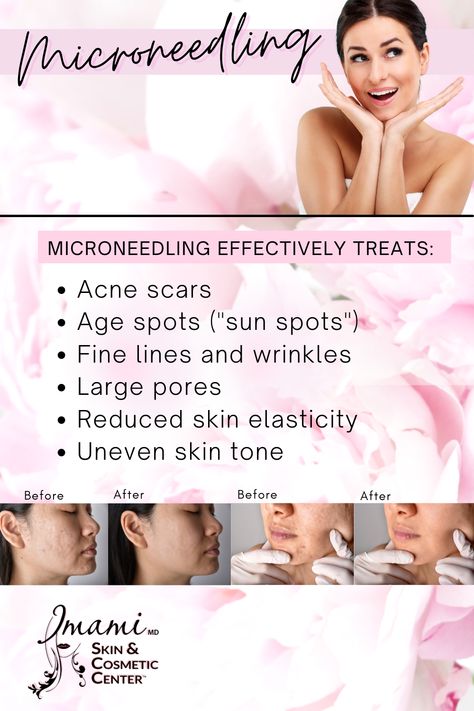 Rf Microneedling Benefits, Microneedling Benefits, Benefits Of Microneedling, Esthetics Business, Health Benefits Of Collagen, Rf Microneedling, Acne Scarring, Derma Pen, Skin Aesthetics