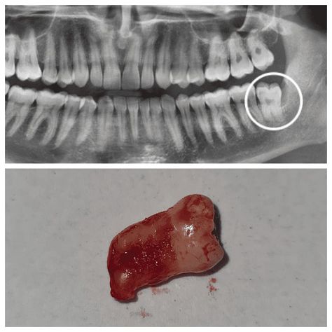 #Dental_implants #Wisdom_teeth #teeth #tooth #dentalhygienist #orthodontics #dentalclinic Are you in several pains and you been referred to a specialist/hospital for a wisdom tooth extraction but the waiting list is to long? We can help you to get ride of the pains. https://thedentistwestmidlands.co.uk/wisdom-teeth Wisdom Tooth Extraction, Wisdom Tooth, Dental Veneers, Tooth Extraction, Dental Crowns, The Dentist, Waiting List, Wisdom Teeth, Dental Hygienist