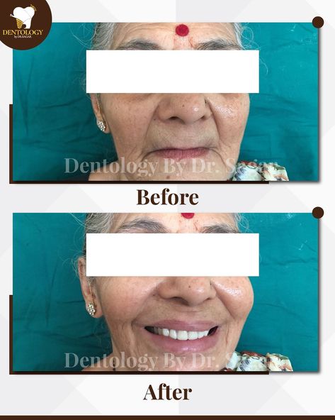 Complete Denture Complete Denture, Dental Appliance, Natural Teeth, Dentures, Tooth Decay, Gum, Disease, Lost