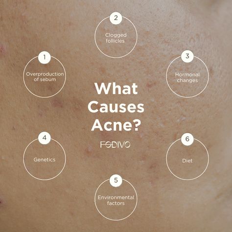 What Causes Acne, Identifying Triggers, Causes Of Acne, Esthetician Inspiration, Skincare Habits, Skin Facts, Skin Care Business, Skincare Products Photography, Social Media Branding Design