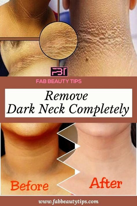 Apply Vaseline & Turmeric on Face to Remove DARK SPOTS in 3 Days - Best Collagen Cream for Wrinkles Dark Spots On Neck, Dark Skin Around Neck, Dark Neck Remedies, Get Rid Of Dark Neck, Skin Lightening Diy, Dark Neck, Glowing Face, Beauty Tips For Glowing Skin, Remove Dark Spots