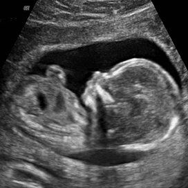 Week 14-1255964591216.xml Baby Gender Ultrasound, Baby Ultrasound Pictures, Pregnancy Images, Baby Weeks, Pregnancy Ultrasound, 4 Month Baby, Baby Ultrasound, Ultrasound Pictures, Fetal Development