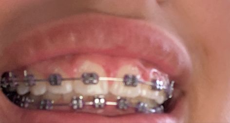 Lavender Braces, Braces Colours, Cute Braces Colors, Cute Braces, Braces Colors, Body Piercings, Braces, Piercings, Lavender