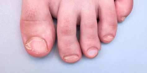 From Split to Brittle: Effective Solutions for Treating Toenail Problems — Tea Nguyen, DPM Split Toenail, Broken Toenail, Toenail Fell Off, Brittle Toenails, Toenail Problems, Injectables Fillers, Ingrown Toe Nail, Brittle Nails, Fungal Infection