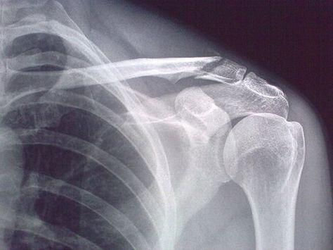 Tumblr Broken Bones X Ray, Shoulder Bones, Head Shoulders, Broken Hearts, Arab Men, Head & Shoulders, Radiology, X Ray, Fascinator