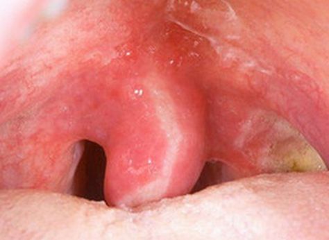 Minor swollen uvula may heal on its own. However, if you're unable to talk, swallow or breathe, seek medical help at once as swollen uvula can cause a very distressing experience. Uvula Swollen Remedies, Swollen Uvula, Swollen Tongue, Swollen Belly, Throat Pain, Soft Palate, Strep Throat, Skin Cream Anti Aging, Snoring Remedies