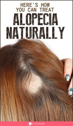 What Is Alopecia And How To Treat It Naturally: Watching clumps of hair fall out of your scalp can never be something you can take lightly. When it gets to the point where you can see bald spots appear on your scalp, it can induce real fear in your heart. Here are some of the best remedies you can try. #Hair #HairCare #Alopecia #Remedies #HomeRemedies #NaturalRemedies Desserts Potluck, Hair Fall Remedy Home, Hair Fall Remedy, Girly Tips, Handmade Socks, Home Remedies For Hair, Healthy Advice, Birthday Blessings, Thicker Hair