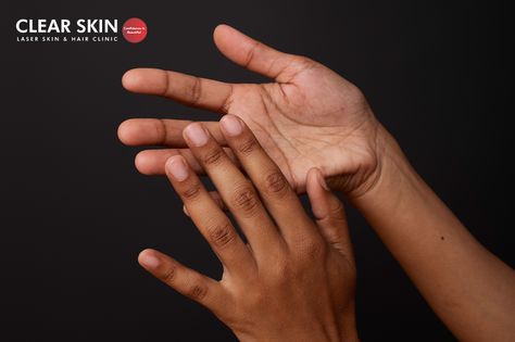 How to Get Rid of Dark Knuckles Fast and Permanently? Dark Knuckles, Skin Lightening Cream, Microblading Eyebrows, Skin Clinic, Skin Discoloration, Beauty Wellness, Skin Tightening, Even Skin Tone, Skin Conditions