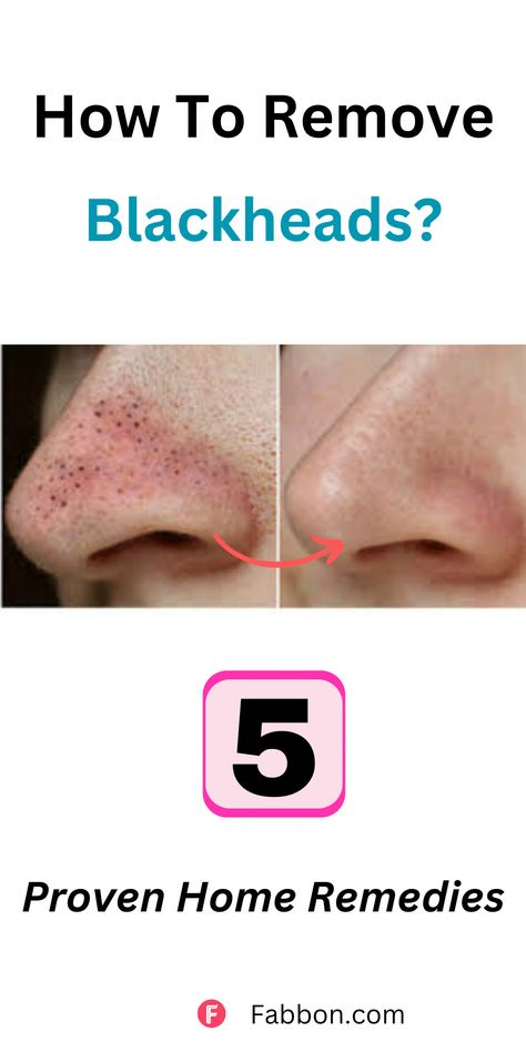 Know how to remove blackheads naturally at home. We uncover the 5 proven home remedies to get rid of blackheads which includes using turmeric, apple cidar vinegar, tomatoes, toothpaste and more! Also know what precautions to be taken to get blackhead free skin! Vinegar Tomatoes, Apple Cidar Vinegar, Apple Cidar, Pore Cleansing Mask, How To Remove Blackheads, Regular Skin Care Routine, For Blackheads, Blackhead Remedies, Hydrating Face Cream