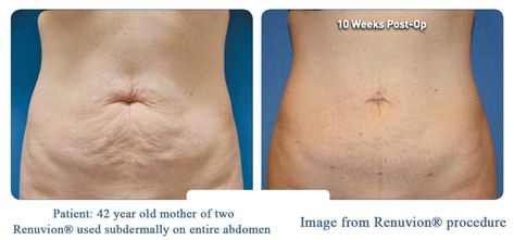 Lipo + Renuvion vs. Tummy Tuck - Omaha Liposuction by Imagen Lipo 360 Before And After, Mommy Makeover Surgery, Mommy Makeover, Saggy Skin, Tummy Tucks