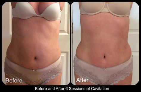 Before and After Cavitation Cavitation Before And After, Lipo Cavitation Before And After, Before And After Cavitation, Ultrasonic Cavitation Schedule, Ultrasonic Cavitation Tips, Home Remedies For Skin, Fat Reduction, Skin Tightening, Home Remedies