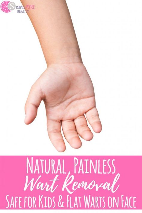 Natural, Painless Wart Removal: Safe for Kids and Flat Warts on Face #diyskincare #wartremoval #plantarwarts #naturalbeauty Flat Warts, Types Of Warts, Warts On Hands, Warts On Face, Home Remedies For Warts, Remove Skin Tags Naturally, Warts Remedy, Remove Warts, Skin Moles