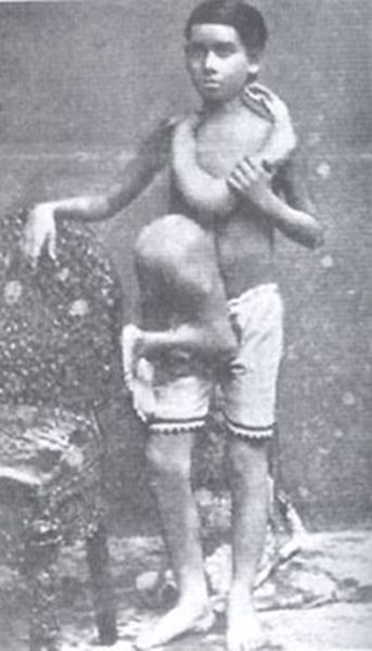 A rare image of young Laloo with parasitic twin (1874 - 1905) Circus Sideshow, Human Oddities, Rare Images, Lion Face, Vintage Circus, Find A Grave, Special People, American Horror, Vintage Photos