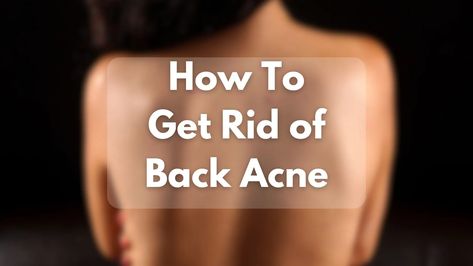 How to get rid of back acne fast with proven home remedies and lifestyle changes. Discover how to prevent bacne and achieve clear skin. Get Rid Of Back Acne, Rid Of Back Acne, Back Acne Remedies, Chest Acne, Back Acne, Fresh Aloe Vera Gel, Proper Hygiene, Golden Rules, Scarring