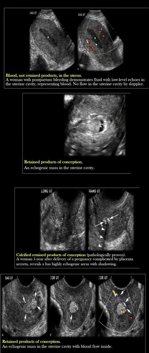 Sonography Notes, Ob Ultrasound, Gyn Ultrasound, Medical Sonography, Medical Ultrasound, Diagnostic Medical Sonography, Ultrasound Technician, Radiology, Ultrasound