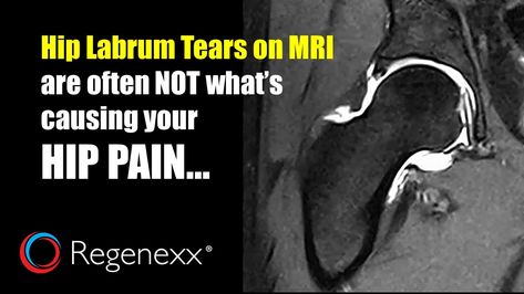 hip labrum tears Labral Tear Shoulder, Hip Health, Torn Labrum, Shoulder Rehab Exercises, Spine Problems, Shoulder Rehab, Bursitis Hip, Hip Exercises, Hip Injuries