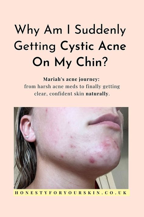 Why am I suddenly getting cystic acne on my chin? What hormone causes hormonal spots on chin? What if my hormones are normal? What Causes Cystic Acne, Chin Acne Causes, Jawline Acne, Clear Skin Remedies, Painful Pimple, Blemish Remedies, Chin Acne, Acne Diet, Pimples On Face